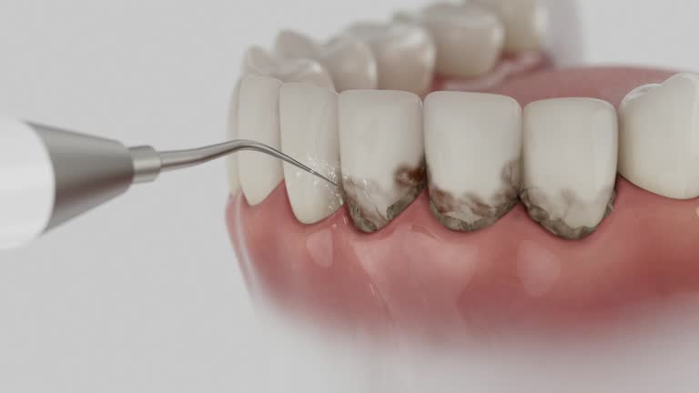 Reliable Dental Implants contractor in Cherokee, NC by Smile Center Dentistry